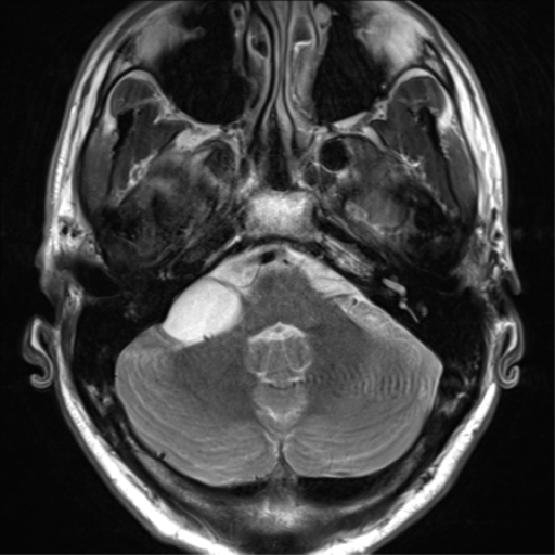 File:Arachnoid cyst - cerebellopontine angle (Radiopaedia 59689-67083 Axial T2 13).png
