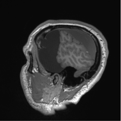 Arachnoid cyst with subdural hematoma (Radiopaedia 85892-101743 Sagittal T1 18).png