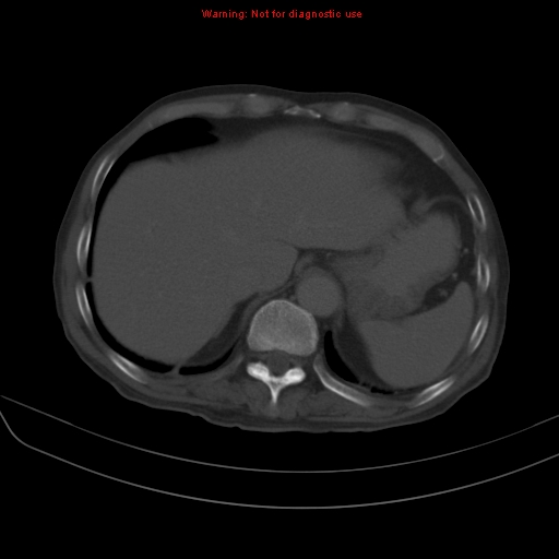 File:Arachnoiditis ossificans (Radiopaedia 51394-57136 Axial bone window 3).jpg