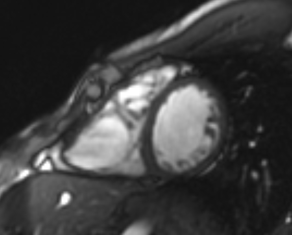 Arrhythmogenic right ventricular cardiomyopathy (Radiopaedia 69564-79464 short axis cine 116).jpg