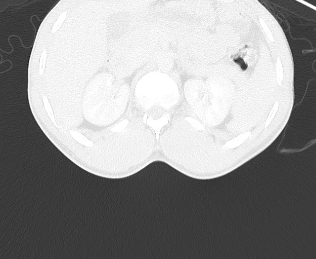 File:Arrow injury to the chest (Radiopaedia 75223-86321 Axial lung window 117).jpg