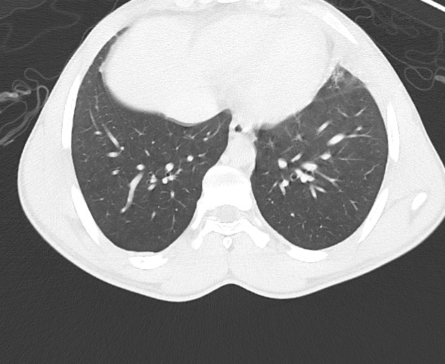 Arrow injury to the chest (Radiopaedia 75223-86321 Axial lung window 65).jpg