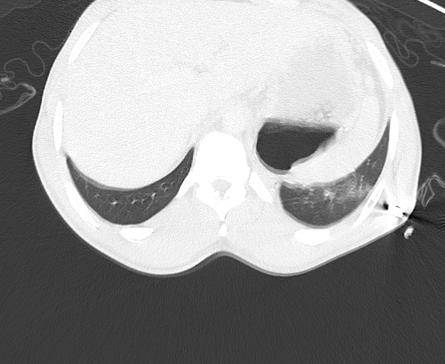 Arrow injury to the chest (Radiopaedia 75223-86321 Axial lung window 94).jpg