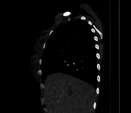 Arteria lusoria (Radiopaedia 88528-105192 C 30).jpg
