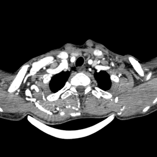 Arteriovenous malformation of the neck (Radiopaedia 53935-60062 A 3).jpg