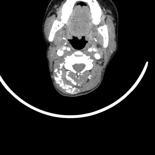 Arteriovenous malformation of the neck (Radiopaedia 53935-60062 A 44).jpg