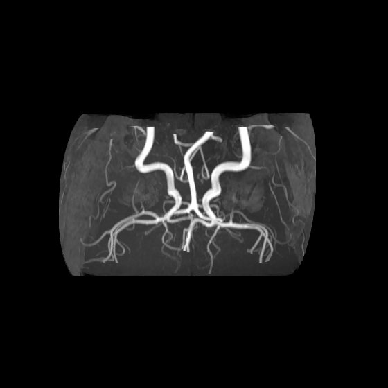 Artery of Percheron infarct (Radiopaedia 40966-43676 F 58).jpg