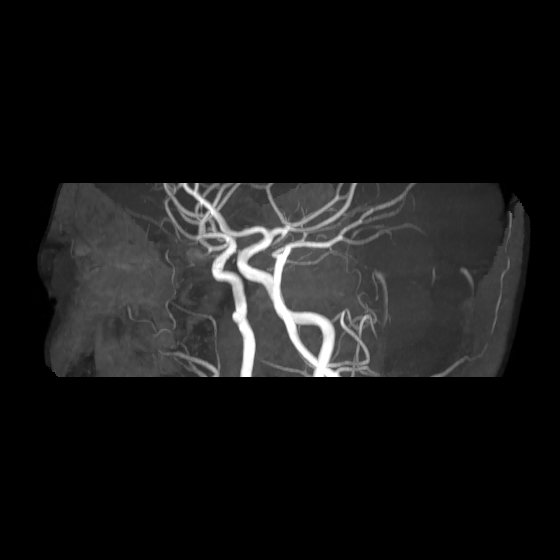 File:Artery of Percheron infarct (Radiopaedia 40966-43676 G 49).jpg