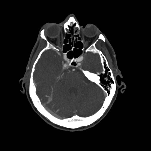 Artery of Percheron infarct (Radiopaedia 48088-52894 A 121).jpg