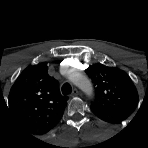 Artery of Percheron infarct (Radiopaedia 48088-52894 A 8).jpg
