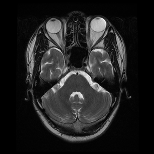 File:Artery of Percheron infarction (Radiopaedia 27975-28230 Axial T2 8).jpg