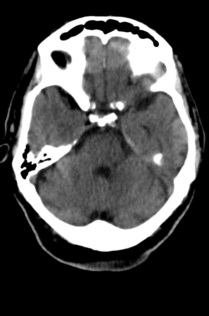 Artery of Percheron infarction (Radiopaedia 80613-94202 Axial non-contrast 65).jpg