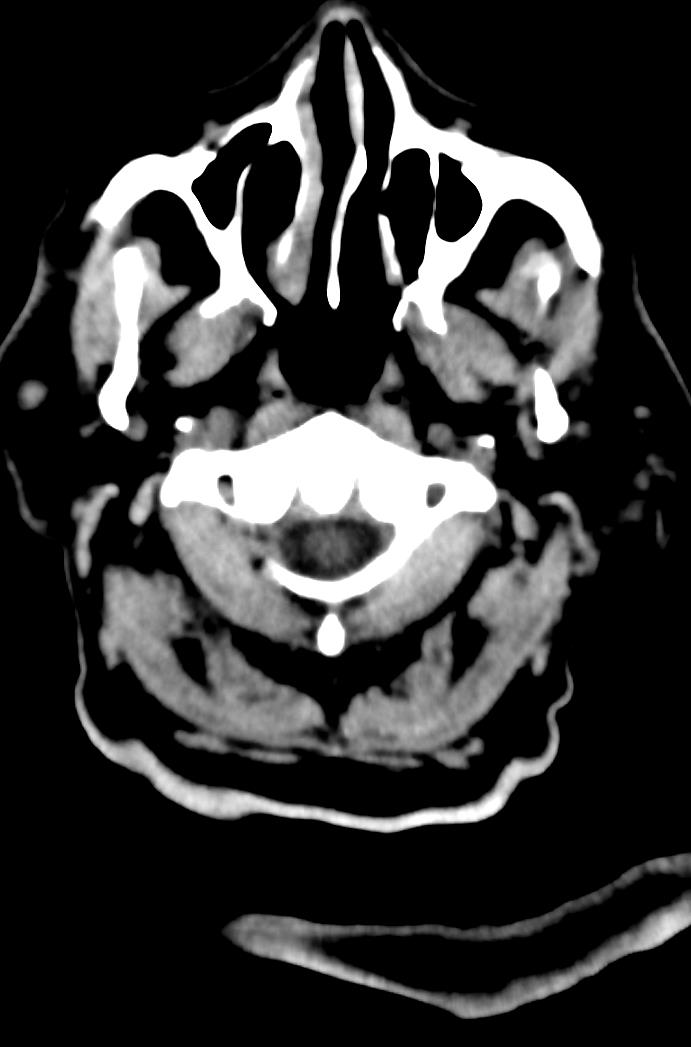 Artery of Percheron infarction (Radiopaedia 80613-94202 Axial non-contrast 7).jpg