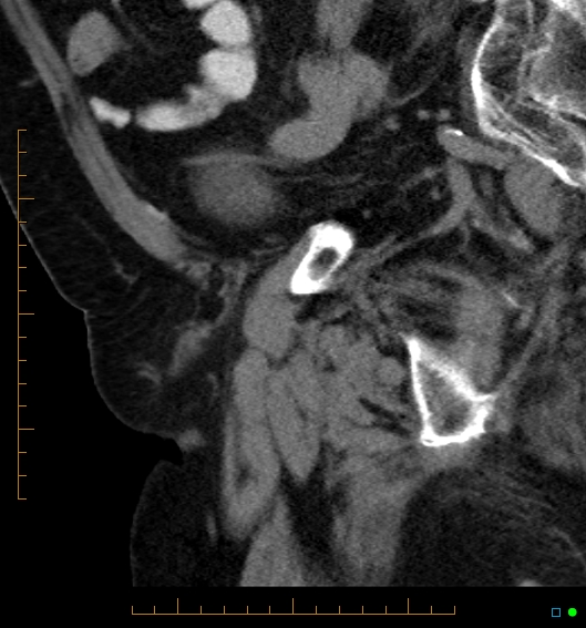 File:Artificial urethral sphincter (Radiopaedia 46937-51464 Sagittal C+ delayed 11).jpg
