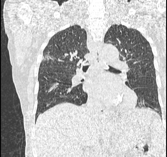 Aspergilloma (Radiopaedia 44592-48327 Coronal lung window 71).jpg