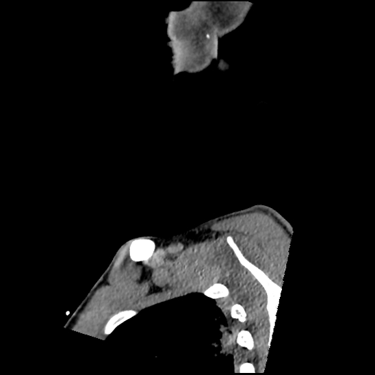 Atlanto-occipital dissociation (Traynelis type 1), C2 teardrop fracture, C6-7 facet joint dislocation (Radiopaedia 87655-104061 D 3).jpg