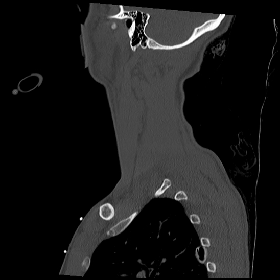 Atlanto-occipital dissociation (Traynelis type 1), C2 teardrop fracture, C6-7 facet joint dislocation (Radiopaedia 87655-104061 Sagittal bone window 59).jpg
