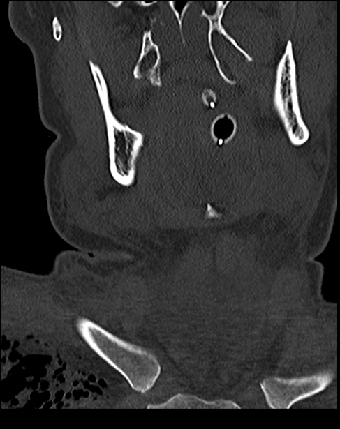 Atlanto-occipital dissociation - Traynelis type 1 (Radiopaedia 87570-103948 Coronal bone window 6).jpg