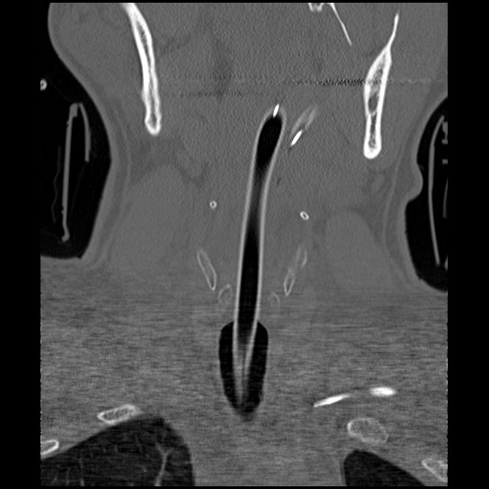Atlanto-occipital dissociation injury (Radiopaedia 29274-29698 Coronal bone window 43).png