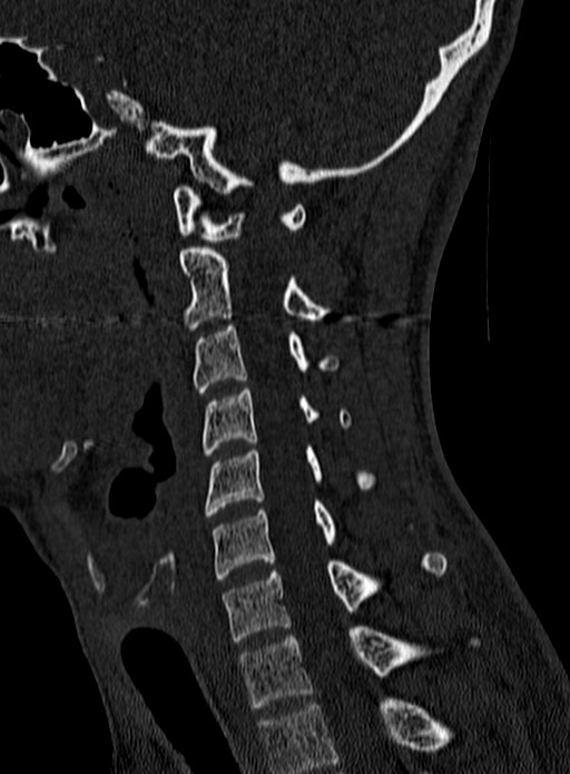 Atlantoaxial subluxation (Radiopaedia 44681-48450 Sagittal bone window 94).jpg