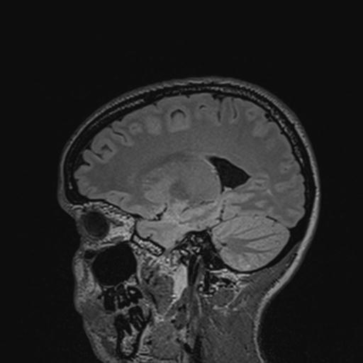 Atretic encephalocoele with inferior vermis hypoplasia (Radiopaedia 30443-31108 Sagittal FLAIR 60).jpg