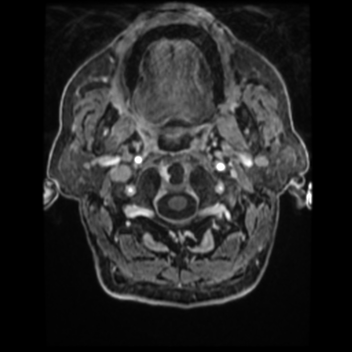 Atypical meningioma (Radiopaedia 45535-49629 Axial T1 C+ 11).jpg