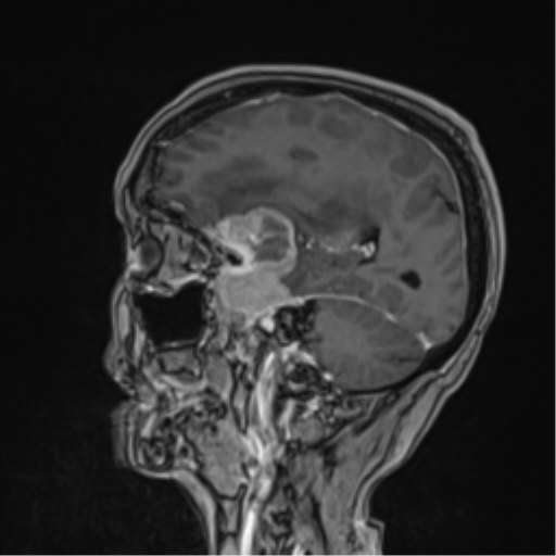 Atypical meningioma (WHO Grade II) (Radiopaedia 54742-60979 Sagittal T1 C+ 48).png