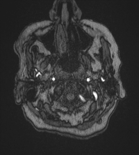 Atypical meningioma (WHO Grade II) (Radiopaedia 54742-60981 Axial MRA 4).png