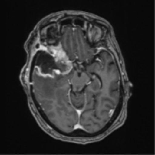 Atypical meningioma (WHO Grade II) (Radiopaedia 54742-60981 Axial T1 C+ 28).png