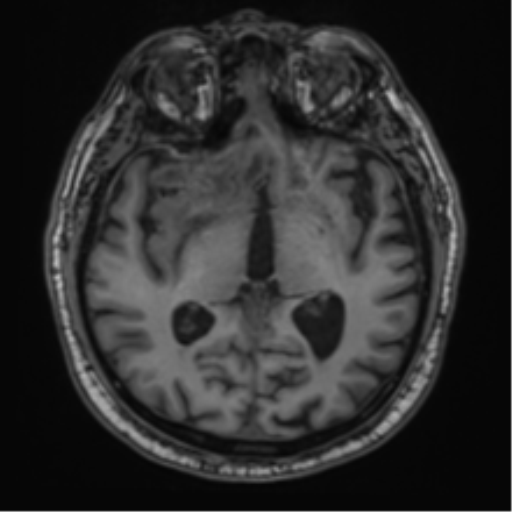 File:Atypical meningioma (WHO grade II) with brain invasion (Radiopaedia 57767-64729 Axial T1 23).png