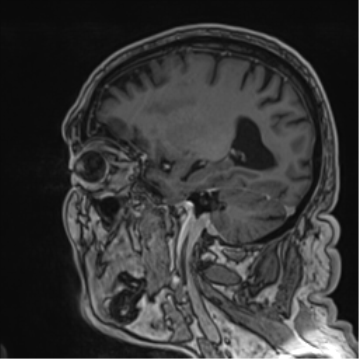 File:Atypical meningioma (WHO grade II) with brain invasion (Radiopaedia 57767-64729 Sagittal T1 C+ 26).png