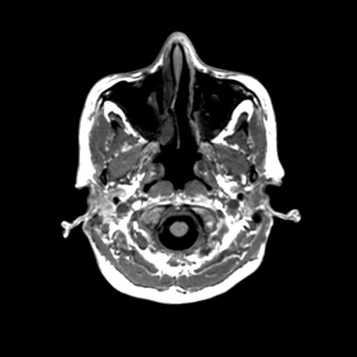 File:Autoimmune limbic encephalitis (Radiopaedia 30363-31005 T1 Axial 1mm 17).jpg