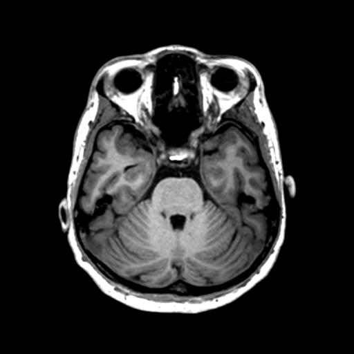 File:Autoimmune limbic encephalitis (Radiopaedia 30363-31005 T1 Axial 1mm 51).jpg