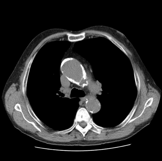 Autosomal dominant polycystic kidney disease (Radiopaedia 27851-28094 Axial non-contrast 21).jpg