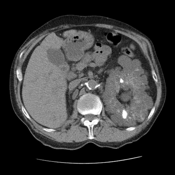 Autosomal dominant polycystic kidney disease (Radiopaedia 27851-28094 Axial non-contrast 63).jpg