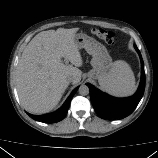 File:Autosomal dominant polycystic kidney disease (Radiopaedia 36539-38101 Axial non-contrast 17).jpg