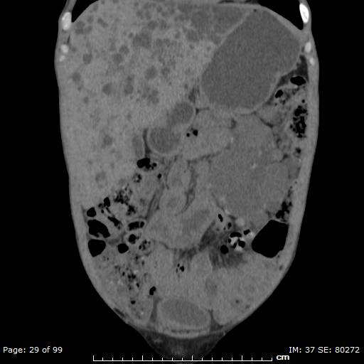 File:Autosomal dominant polycystic kidney disease (Radiopaedia 44122-47684 Coronal 17).jpg