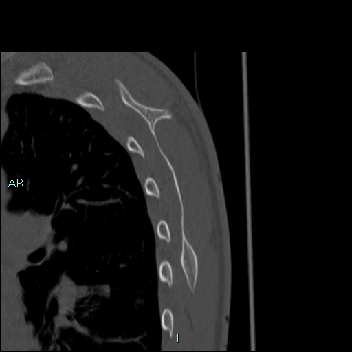 File:Avascular necrosis after fracture dislocations of the proximal humerus (Radiopaedia 88078-104653 Sagittal bone window 76).jpg