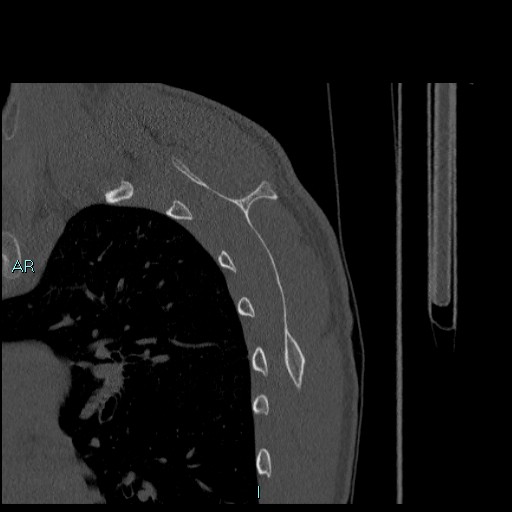 Avascular necrosis after fracture dislocations of the proximal humerus (Radiopaedia 88078-104655 Sagittal bone window 66).jpg