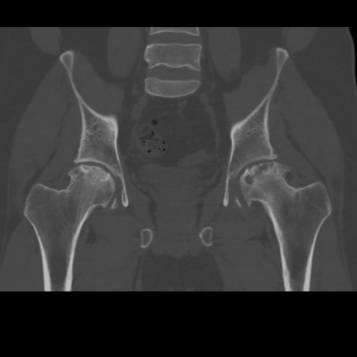 File:Avascular necrosis of the hip (Radiopaedia 61503-69467 Coronal bone window 19).jpg