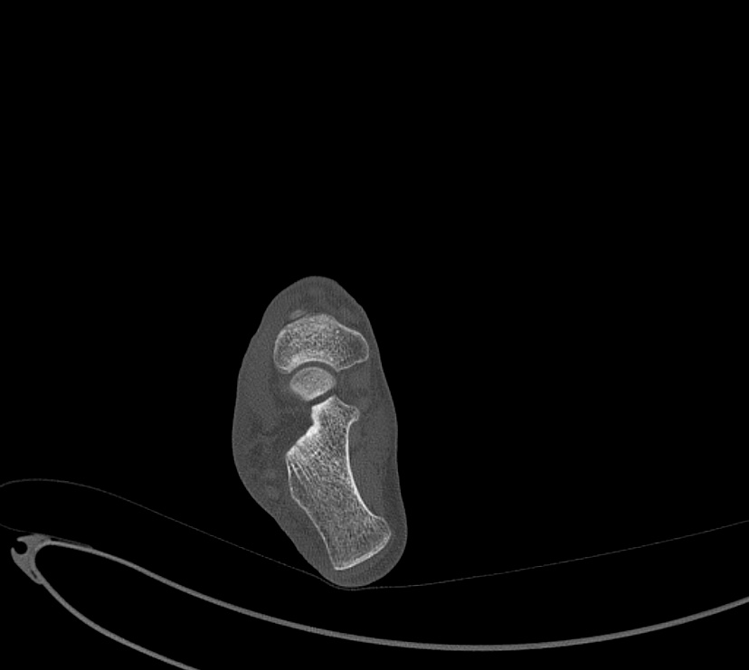Avulsion fractures of talus and calcaneus (Radiopaedia 48277-53155 Axial bone window 58).jpg