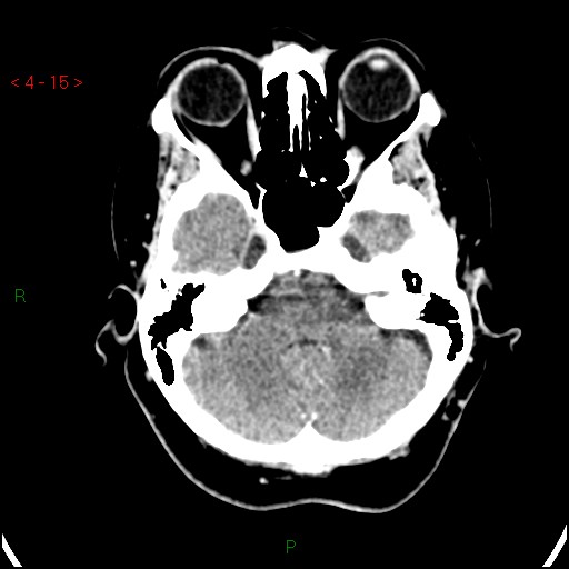 Azygos anterior cerebral artery (Radiopaedia 51987-57833 A 15).jpg