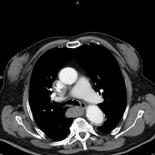 File:Azygos continuation of the inferior vena cava (Radiopaedia 18537-18404 C+ arterial phase 23).jpg