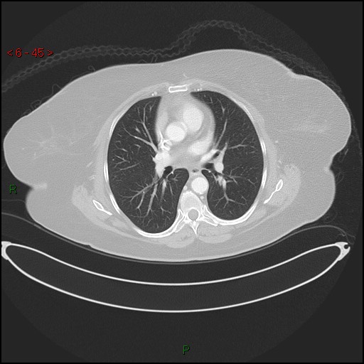 File:Azygos fissure and lobe (Radiopaedia 47620-52278 Axial lung window 45).jpg