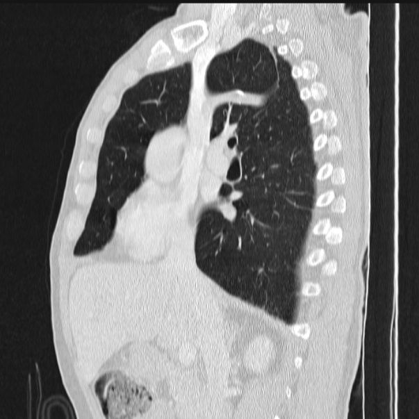 Azygos lobe (Radiopaedia 38259-40275 lung window 43).jpg