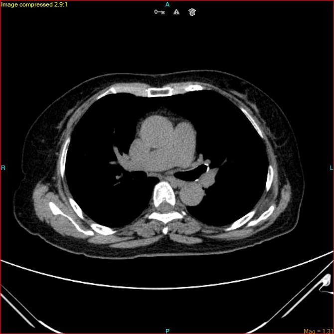Azygos vein aneurysm (Radiopaedia 77824-90130 A 29).jpg