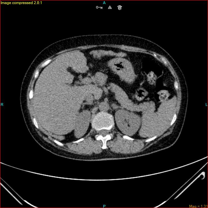 Azygos vein aneurysm (Radiopaedia 77824-90130 A 55).jpg