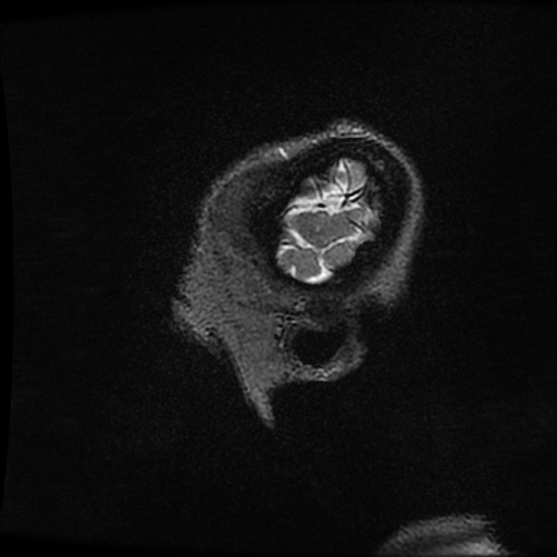 Balo concentric sclerosis (Radiopaedia 53875-59982 Sagittal 3D FSE 8).jpg
