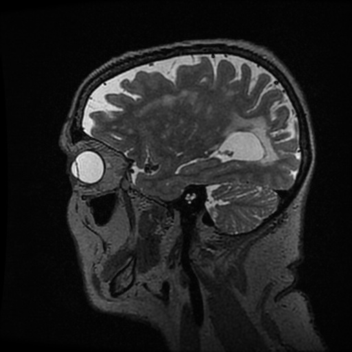 Balo concentric sclerosis (Radiopaedia 53875-59982 Sagittal 3D FSE 80).jpg