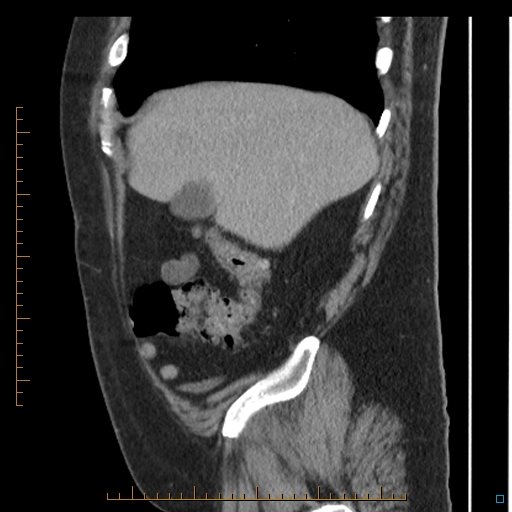 Bariatric balloon causing gastric outlet obstruction (Radiopaedia 54449-60672 C 67).jpg